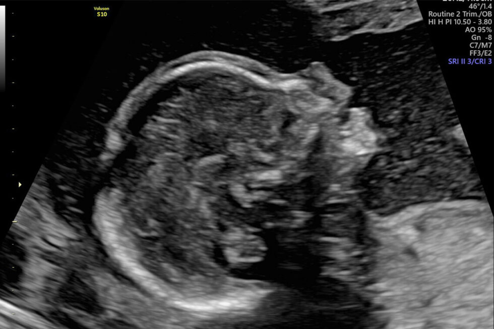 20 Weken echo - Echocentrum Almere